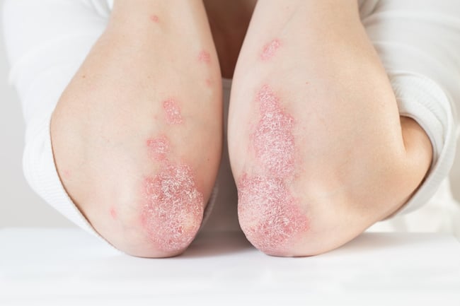 psoriasis on a patient's elbows